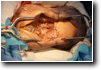 Dural tube is exposed
